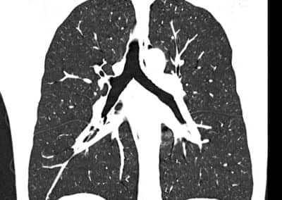Röntgenaufnahme Lunge