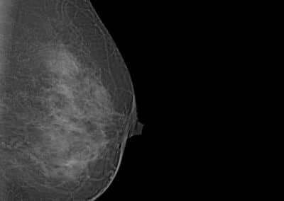 Système de mammographie Xenox S100
